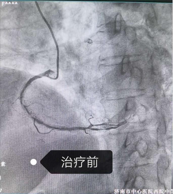 心内介入治疗前_meitu_1.jpg