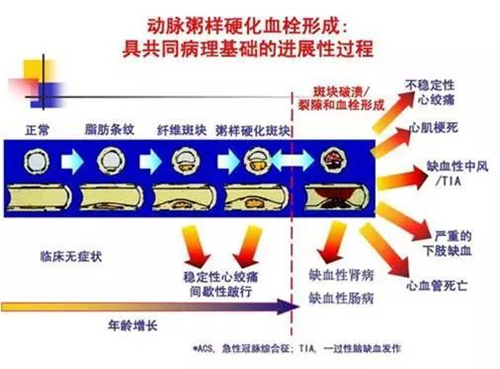 图片2动脉粥样硬化.png