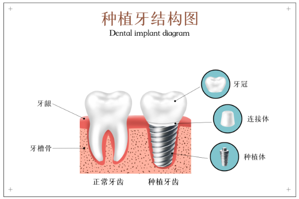 摄图网_401804175_种植牙结构示意图（企业商用）.jpg