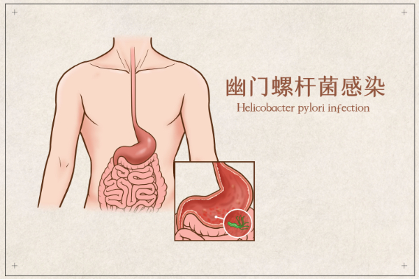 摄图网_401789751_幽门螺杆菌感染医疗插画（企业商用）.jpg