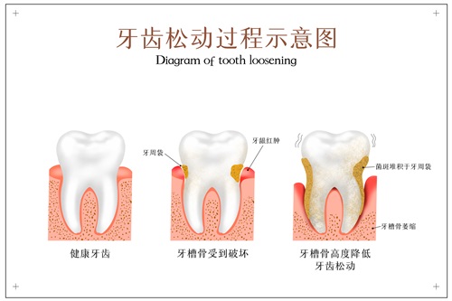 摄图网_401864198_牙齿松动过程牙科配图（企业商用）.jpg