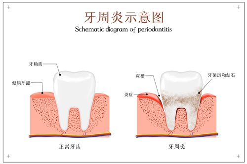 摄图网_401803633_牙周炎示意图（企业商用）.jpg